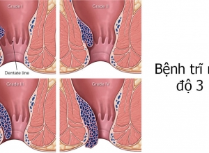 Trĩ nội chảy máu nên xử lý như nào? TÌm hiểu ngay để biết